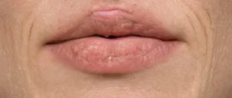 Влияние курения на кожу и эффективные способы устранения последствий