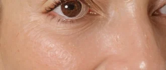Эффективные кислоты для борьбы с возрастными изменениями кожи